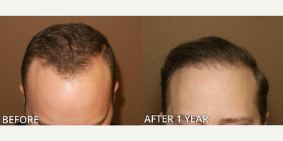 Man treated with Hair Transplant, FUE Hair Transplant - Man treated with Hair Transplant, FUE Hair Transplant