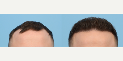 25-34 year old man treated with FUE Hair Transplant, Hair Transplant, Hair Loss Treatment, PRP for Hair Loss, NeoGraft - Dr. Wise performed an FUE hair transplant on this patient to reinforce a receding hairline and add density. Using 3,020 grafts and one session of PRP, this patient is seeing fantastic results at 6 months post-op!