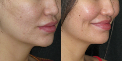 25-34 year old woman treated with Dimple Surgery - Dimples are created from the inside of the mouth. Initially they are visible even with no smile but then they fade away at rest and appear with smile, just like natural dimples. The shape and depth is variable based on each individual.
