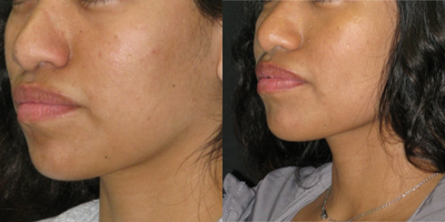 25-34 year old woman treated with Dimple Surgery - Patient with thinner cheeks get better results than patients with thicker cheeks. Initially the dimples are visible even at rest but later they fade away at rest and only appear when smiling. The last set of pictures demonstrates this.