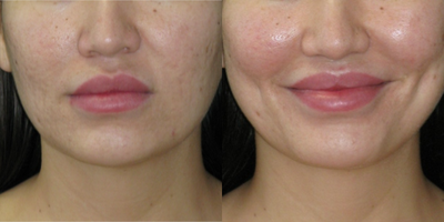 25-34 year old woman treated with Dimple Surgery - Dimples are created from the inside of the mouth. Initially they are visible even with no smile but then they fade away at rest and appear with smile, just like natural dimples. The shape and depth is variable based on each individual.