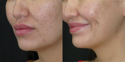 25-34 year old woman treated with Dimple Surgery - Dimples are created from the inside of the mouth. Initially they are visible even with no smile but then they fade away at rest and appear with smile, just like natural dimples. The shape and depth is variable based on each individual.