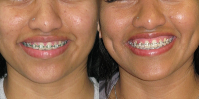 25-34 year old woman treated with Dimple Surgery - Patient with thinner cheeks get better results than patients with thicker cheeks. Initially the dimples are visible even at rest but later they fade away at rest and only appear when smiling. The last set of pictures demonstrates this.
