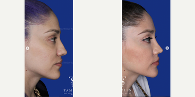 Woman treated with Rhinoplasty - Beautiful results just 7 months following Rhinoplasty.This patient wanted her nose to be more refined while still looking natural and like herself.Following surgery, she is breathing great and loves her new elegant look!