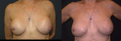 73 Year Old Female, 5'6,  134 lbs.  1 child - 
	Bilateral Removal of 39 Year Old Ruptured Silicone Implants and Placement of 270cc Moderate Profile Gel Implants, Bilateral Total Capsulectomy

