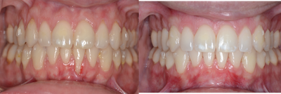 Gum Recession Repair - Patient presented for exposed root coverage. Gum recession is very common and root exposure is very detrimental to the health of the teeth. In one procedure I was able to repair, cover and improve the quality and quantity of gum tissue. This will significantly improve her oral health over a lifetime.