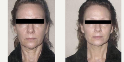 45-54 year old woman treated with TITAN - Skin tightening with TITAN for lower face/ jawline
