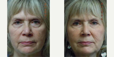 55-64 year old woman treated with Juvederm, Laser Resurfacing - This patient is a 62-year-old woman from North Idaho concerned about the typical changes of the aging face which include: wrinkles, texture changes, fine lines, volume loss, laxity, and facial drooping of the cheeks and at the corners of the mouth. She also has concerns about love handles and varicose veins. All of these issues were addressed and the patient was evaluated with a Visia computerized digital complexion analysis. The most striking issue was the loss of volume in the midface and a tear trough deformity which typically causes our patients to complain of either dark circles under the eyes or bags under the eyes. Treatment recommendations consisted of CO2 fractional resurfacing, dermal fillers, and Smartlipo body sculpting for the muffin tops. Choosing to get the most bang for the buck, we agreed on facial rejuvenation and volume restoration with JUVDERM Ultra XC and JUVEDERM Ultra Plus XC, which is formulated with the numbing medication Lidocaine for more comfort during the procedure. We placed a total of 6 syringes of the dermal filler in the tear troughs, midface, and at the corners of the mouth (oral commissure). As you can see, this created a fresher, more rested, and younger look without looking artificial or plastic. Many of our dermal filler patients are thrilled with the immediate improvement that fillers create in a procedure that is comfortable for them and takes less than an hour.