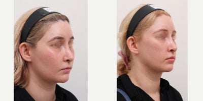 25-34 year old woman treated with Nonsurgical Facelift, AccuLift, Liposuction - Chief Complain: uneven face lines, hollowed under eyes, chubby cheeks, squared face shapeTreatment Plan: facial fat graft, under eye fat reposition, face liposuction ( cheeks, double chine, zygomatic angle) Outcome: - smooth V-lined face line - younger and refreshed look