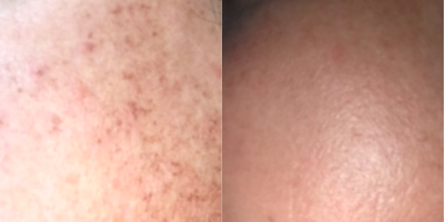 35-44 year old woman treated with Laser Treatment - One treatment with Lumecca IPL on face. After photo is post one week.