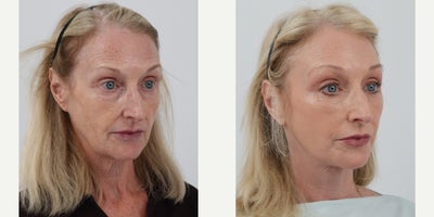 65-74 year old woman treated with Facelift, Neck Lift, Brow Lift, Eyelid Surgery, Facial Fat Transfer, Chemical Peel - 66 year old 2.5 months post Facelift, Neck lift, Brow Lift, Lower Bleph, Fat transfer and TCA peel