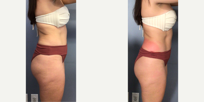 25-34 year old woman treated with Cryoskin - 1st cryoslimming on handles (back)