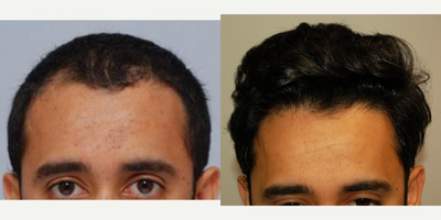 25-34 year old man treated with Hair Transplant - Before and After photos of hair restoration surgery performed by Dr. Ken Anderson.