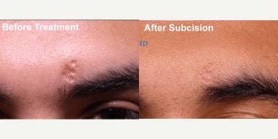 18-24 year old man treated with Subcision - Patient came in with this deep, atrophic scar from shingles above his left eyebrow. Patient was very concerned about the indent and wanted to make it more shallow. We performed two sessions of subcision and were able to lift the scar. He is pleased, but we would be able to continue treatment if he wanted!