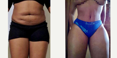 Results after Full Body Intense Liposuction and Dominican Butt Lift - Outcome after Full Body Intense Liposuction including abdomen, waist, laterals, upper and lower back plus Dominican Butt Lift getting better volume, contour and butt projection.