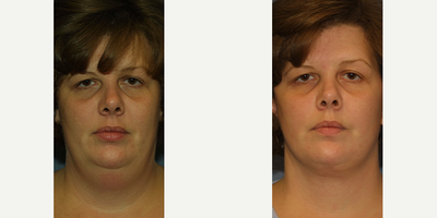 Woman treated Neck Liposuction - Woman treated with neck liposuction
