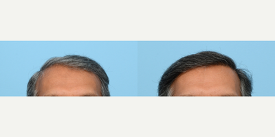 55-64 year old man treated with FUE Hair Transplant, Hair Transplant, Hair Loss Treatment, PRP for Hair Loss, NeoGraft - This patient underwent an FUE hair transplant with Dr. Wise to regrow lost hair and add more density to thinning areas. Additionally on the day of the procedure he received one PRP therapy treatment.