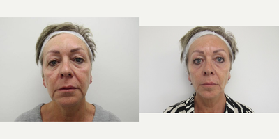 45-54 year old woman treated with Silhouette Soft - Client was treated with a total of x6 silhouette soft threads (thread to midface to treat nasolabial fold, thread to treat marionette fold and thread to jawline to improve jowl). Images taken 3 months apart. Results last 15-18 months. Cost 2100.