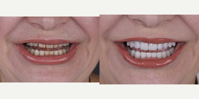 45-54 year old woman treated with Lumineers, Porcelain Veneers - woman treated with Lumineers, Porcelain Veneers