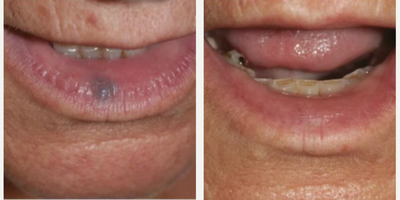 Man treated with YAG Laser - This is a venous lake on the lip and is treated by the ClearV vascular laser.