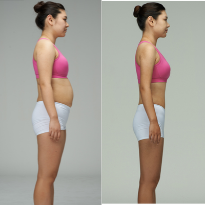 woman treated with Body Jet(Whole body liposuction) - Before and After photo of Whole body liposuction with Body Jet&nbsp;