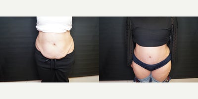 45-54 year old woman treated with Drainless Tummy Tuck - 45-54 year old woman treated with Drainless Tummy Tuck