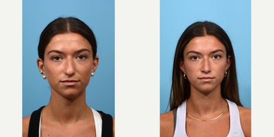 18-24 year old woman treated with Septoplasty - septo- and rhinoplasty