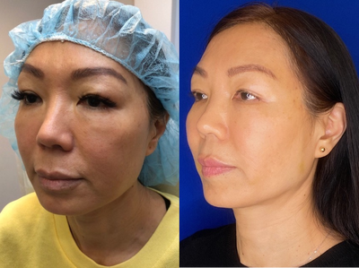 Woman treated with Thread Lift - Woman treated with Thread Lift, shown 2 weeks post op.