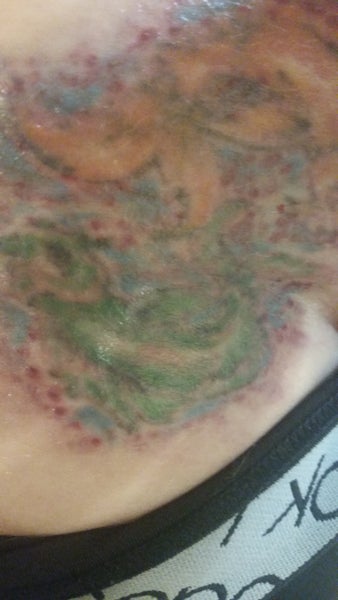 Red dots after tattoo removal. Any suggestions? (photos ...