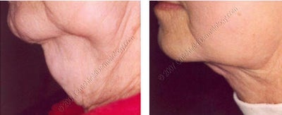 Lipodissolve before and after on chin - 
	Lipodissolve
