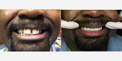 35-44 year old man treated with Porcelain Veneers - This patient had significant diastema (i.e., Gap between two front teeth). It only took 2 appointments with Dr. Sarah Thompson to totally transform this patient's appearance. Dr. Thompson placed 6 porcelain veneers to achieve this smile in this patient. Patient's porcelain veneers should last at least 20 years with regular semi annual dental check-ups and recommended daily brushing and flossing.