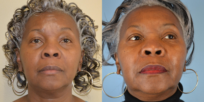 65-74 year old woman treated with ArteFill - 65 year old female received Artefill to nasolabial folds and cheeks