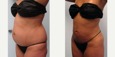 Woman treated with Liposuction, Brazilian Butt Lift, Butt Augmentation, Butt Lift - Woman treated with Liposuction, Brazilian Butt Lift, Butt Augmentation, Butt Lift