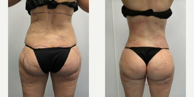 Woman treated with Liposuction - FORGET THE BBL. Get your GBB. GruBer Booty. All of the look with none of the risk or downtime of a BBL/fat transfer. AWAKE LIPO and shaping of your natural curves allows you to be back to work in just a few days and there are no sitting restrictions. THE GRUBER BOOTY. Awake lipo only. THIS IS NOT A BBL. NO implants, NO fat grafts. Precise and artistically performed lipo by Dr. Meegan Gruber, Board Certified Plastic Surgeon. All the shape without the downtime, risks of fat transfer and possible fat loss. AWAKE LIPOSUCTION.