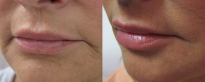 45-54 year old woman treated with Lip Augmentation with ALMI fat transfer - Lip enhancement with micronized autologous fat using the ALMI technique.