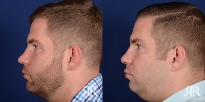 Rhinoplasty - Rhinoplasty