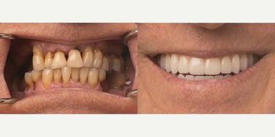 45-54 year old man treated with All-on-4 Dental Implants, Dental Implants - This patient came to us with multiple broken and missing teeth, making it difficult to eat, speak, and feel confident in their smile. Through a customized dental implant treatment, we were able to restore both the appearance and function of their teeth. Now, they have a strong, natural-looking smile!