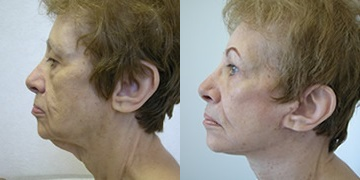 Woman treated with Facelift - Woman treated with Facelift