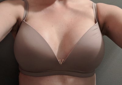 Breast Augmentation utilizing 325cc Moderate Plus Silicone…