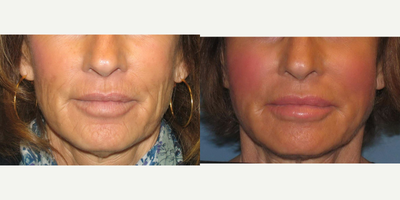 Bellafill - Patient was treated with a Bellafill dermal filling procedure. Facial wrinkles are smoothed out for a more beautiful, youthful look.