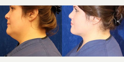 Woman treated with Chin Liposuction - Woman treated with Chin Liposuction