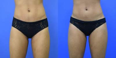 25-34 year old woman treated with Hip Augmentation - This 25-year-old patient of Dr. Bachilo desired a subtle and natural enhancement to her hips. She is seen here before and after just one month after a bilateral hip augmentation using silicone hip implants.