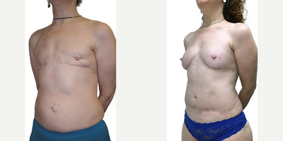 46 year old woman treated with DIEP flap breast reconstruction - This 46 year old mother had right breast cancer. She chose a double mastectomy. Due to damage caused by the mastectomy surgery, implants didn't take. Dr. Rad rebuilt her breasts with bilateral DIEP flaps.