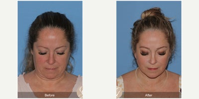 45-54 year old woman treated with Deep Plane Facelift, Neck Lift, Brow Lift, CO2 Laser, MACS Facelift - 52 year old treated with Deep Plane Face and Neck Lift, Temporal Brow Lift, CO2 Laser of Face, MAC