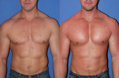 Male Pectoral Implants - before and after pec implants using a vertically placed implant that will produce more medial and upper chest fullness