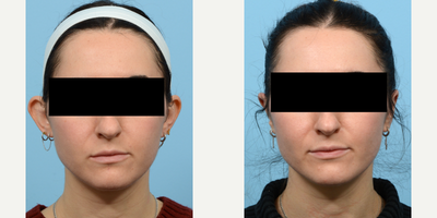 25-34 year old woman treated with Ear Surgery - Two month post-op results of otoplasty with Dr. Wise: This 28-year-old patient feels much more confident in her appearance now that her ears protrude less.