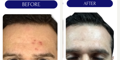 45-54 year old man treated with YAG Laser, Laser Resurfacing, CO2 Laser, UltraPulse CO2 Laser, Fractional Laser - LASER ACNE TREATMENT
