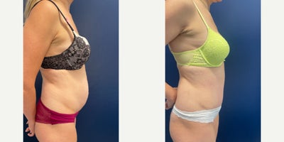 35-44 year old woman treated with Tummy Tuck, Liposuction, Power-Assisted Liposuction (PAL), Abdominal Etching, Umbilical Hernia - This beautiful mom of two underwent Tummy tuck with Liposuction, as well as Diastasis Recti Repair to create a flatter and more defined abdominal contour.  Her umbilical hernia was repaired and reconstructed at the same time creating a small innie belly button with minimal scarring on the outside.The scars will continue to fade over time.