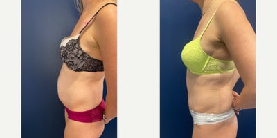35-44 year old woman treated with Tummy Tuck, Liposuction, Power-Assisted Liposuction (PAL), Abdominal Etching, Umbilical Hernia - This beautiful mom of two underwent Tummy tuck with Liposuction, as well as Diastasis Recti Repair to create a flatter and more defined abdominal contour.  Her umbilical hernia was repaired and reconstructed at the same time creating a small innie belly button with minimal scarring on the outside.The scars will continue to fade over time.