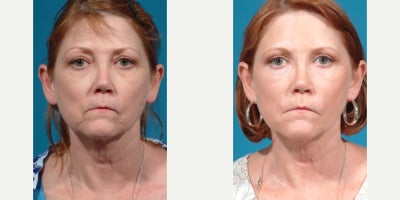55-64 year old woman treated with Facelift, Mini Facelift, SMAS Facelift, Lower Facelift, Deep Plane Facelift - Before and after facelift/necklift